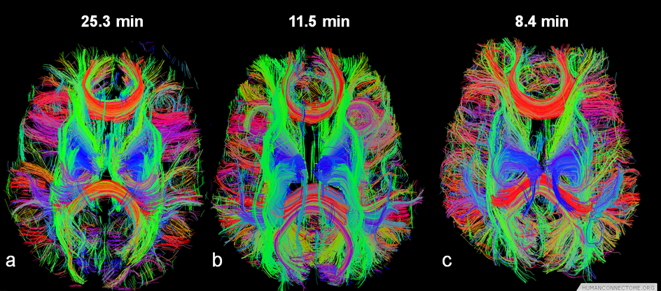 인간 뇌의 초음파 평면 이미지(EPI: Echo-Planar Imaging) 사진. 미국 국립보건원(NIH)의 지원으로 뇌의 기능적, 해부학적 네트워크를 연구하고 있다. 이 연구에는 워싱턴, 미네소타, 옥스포드, 세인트루이스, 인디애나 등 주요 대학교들이 참여하고 있다. ⓒHumanConnectome.org