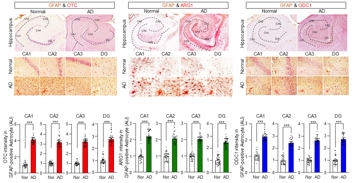 [그림 2] 알츠하이머 환자에서 보이는 요소회로 효소의 증가 
            알츠하이머 환자 뇌에서도 별세포 특이적으로 요소회로 효소 (OTC, ARG1, ODC1)이 증가한 것을 확인했다.