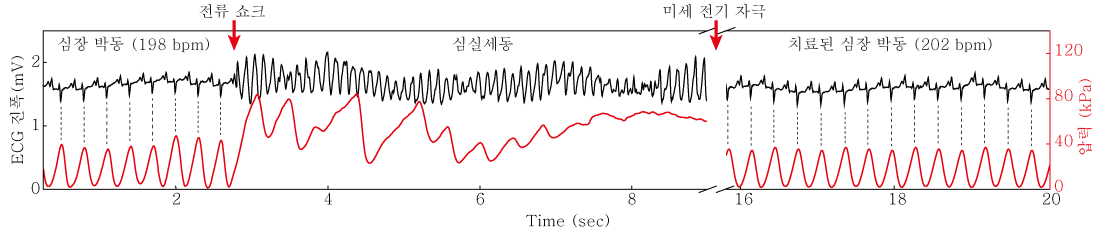 [그림4] 실시간 심실 세동 부정맥 진단 및 치료 데이터
        전자 패치를 이용한 심실 세동을 진단하고 치료 기능을 수행함(빨간색 선)