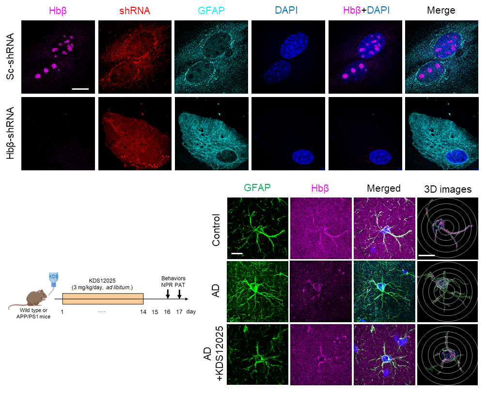Figure 3. (Top) Hemoglobin is present in the nucleolus of astrocytes. When astrocytic hemoglobin is knocked down, KDS12025 loses its effect, confirming that the drug’s antioxidant action is mediated through astrocytic hemoglobin. (Bottom) In Alzheimer’s mice, astrocytes (green, GFAP) are atrophied and hemoglobin (purple, Hbβ) is reduced, whereas KDS12025 treatment restores astrocyte morphology and hemoglobin expression.