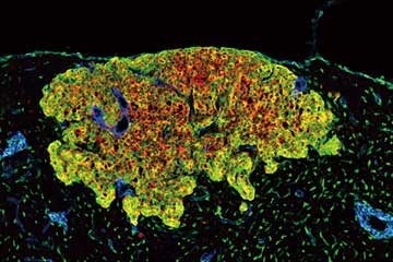 How do metastatic tumor cells grow in lymph node?