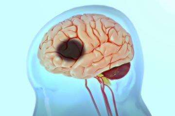 A novel therapeutic target for recovery after stroke