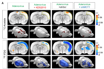 A new breakthrough in Alzheimer disease research - visualizing reactive astrocyte-neuron interaction