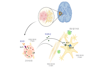 최적의 뇌종양 수술 위치, 반응성 별세포 영상으로 찾는다