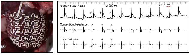 실험쥐의 심장에 감싼 심외막 그물막(왼쪽)과 심전도 측정 그래프. 전도성 고무 덕분에 훨씬 안정적인 심장 전기 신호를 보인다. (출처: 기초과학연구원)
