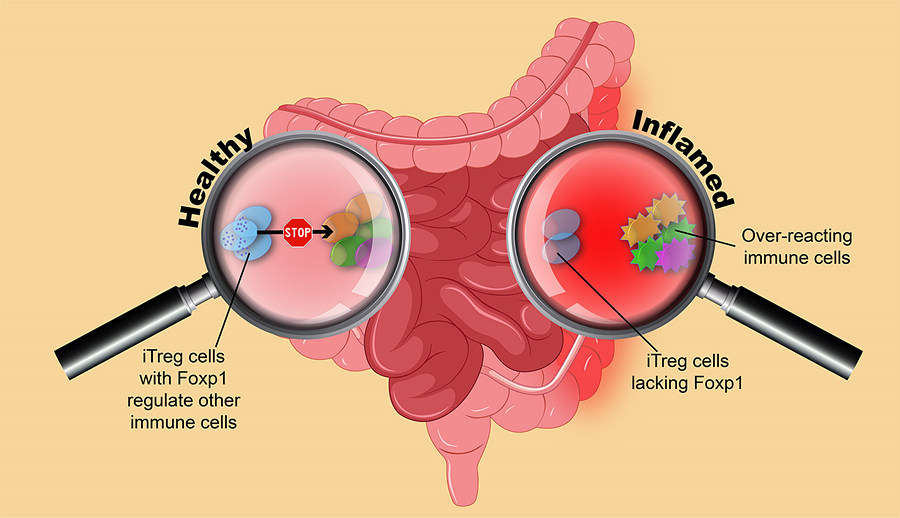 Figure 1: Lack of Foxp1 leads to inflammation of the large intestine (colitis). (Left) In healthy conditions, iTreg cells (blue) with sufficient Foxp1 keep a check over other immune cells (T-cells, orange, green and purple) in the large intestine. (Right) If Foxp1 is absent, iTreg cells are dramatically reduced and therefore can't control the activity of other immune cells. As a consequence, T-cells over-react against harmless gut bacteria and food, causing irritation, inflammation, and leading to colitis and ulcer. (Modified from Brgfx - Freepik.com)