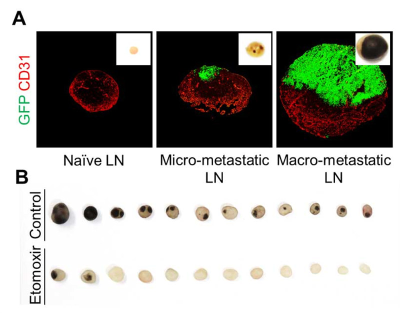 [Figure 2] (A) Stepwise growing metastatic melanoma in tumor-draining lymph node and (B) fatty acid oxidation inhibitor, Exomoxir, suppresses lymph node metastasis