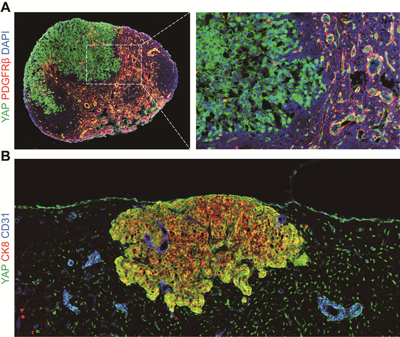 [Figure 3] Immunofluorescence images showing YAP activation (green) in metastatic melanoma