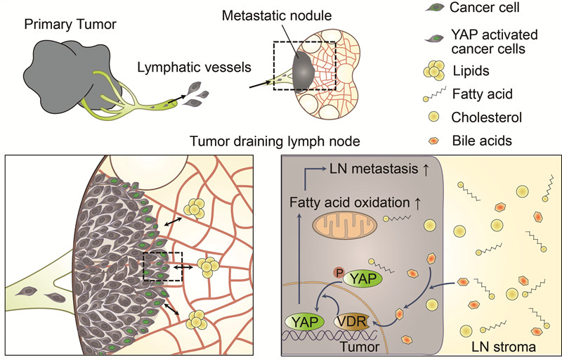 [Figure 1] Schematic diagram for the mechanism of tumor lymph node metastasis