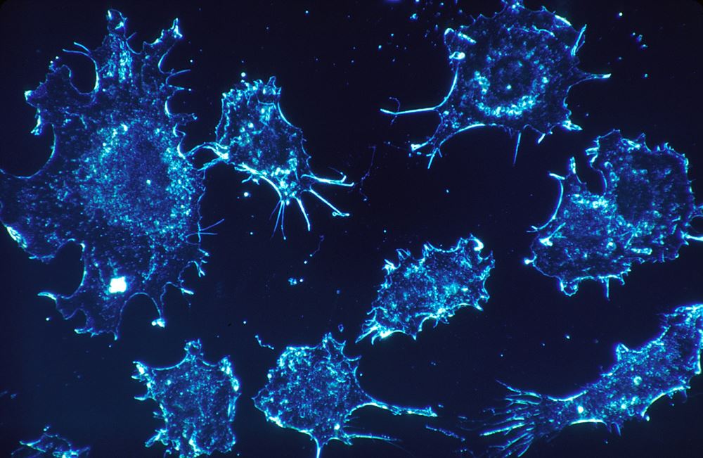  IBS 복잡계 자기조립 연구단은 암 줄기세포를 표적하는 형광물질을 개발하고, 이를 통한 항암 효과까지 확인했다. 사진은 암세포의 모습. (출처: Pixabay)