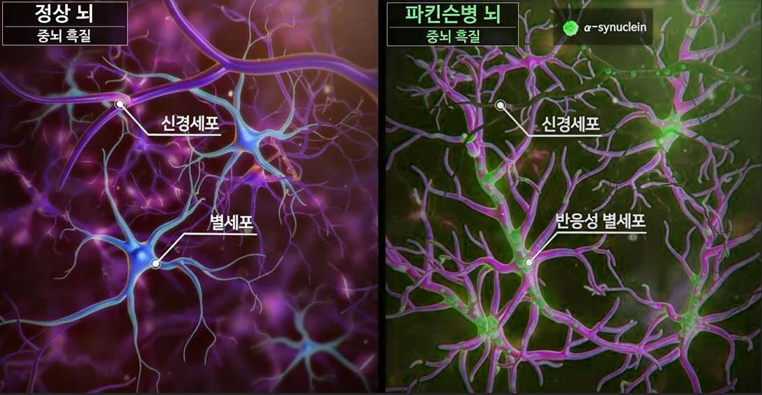 파킨슨병 환자의 중뇌 흑질은 정상인에 비해 별세포가 반응성을 띠고 있고, 신경세포의 기능이 멈춰있다.