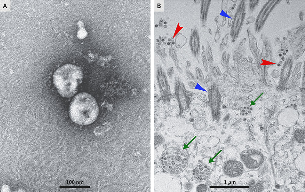 폐렴환자로부터 분리한 2019-nCoV를 투과전자현미경(TEM)으로 관찰한 이미지(A)와 사람 호흡기 상피세포에 감염된 2019-nCoV의 전자현미경 이미지(B). 섬모(파란색), 세포 외 바이러스입자(빨간색), 봉입체(바이러스 덩어리, 초록색)의 모습을 관찰할 수 있다. (출처: Zhu et al., 2020)