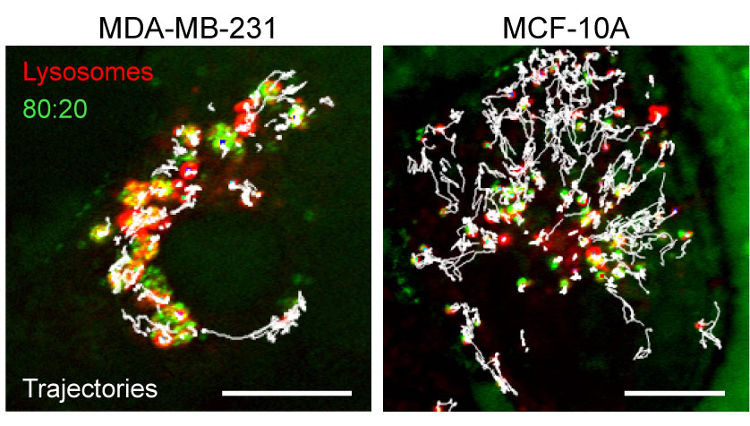 Figure 2. The effect of nanoparticle aggregation inside lysosomes. The image shows the trajectories (white) of lysosomes (red) in cancer (on the left) versus normal (on the right) cells. Nanoparticle aggregates (green) in cancer cells impaired lysosomes’ ability to survey the interior of the cell. Scale bar, 10 m.