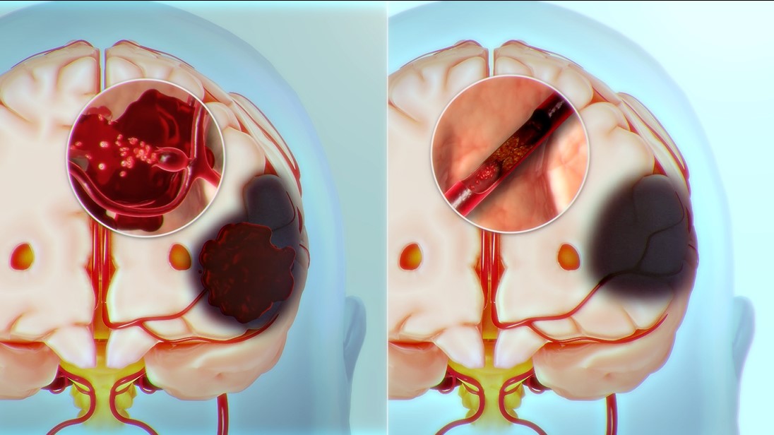 뇌졸중은 뇌혈관이 터지거나(좌) 막혀(우) 혈액을 공급받지 못하는 뇌 부위가 손상되는 질환이다. 언어장애(실어증), 반신마비, 치매, 성격변화, 식물인간, 대소변 못가림, 연하곤란(삼킴 장애) 등 다양한 후유증이 남는 심각한 질환이지만, 아직까지 뚜렷한 치료법이 없다.