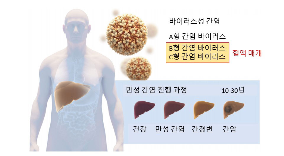 그림 3. 두 가지 유형의 간염. 첫째 유형은 A형간염 바이러스에 발생하는 급성질환이며 오염된 물이나 음식물에 의해 전염된다. 혈액 매개 간염인 두 번째 유형은 B형과 C형 간염바이러스에 의해 일어나는 만성 질환으로써 간 병증과 간암으로 진행된다. 출처: 노벨재단