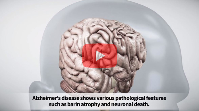 Overly reactivated star-shaped cells explain the unpredictability of Alzheimer’s disease (Credit: IBS)