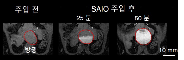 그림 3. SAIO 방광 배출