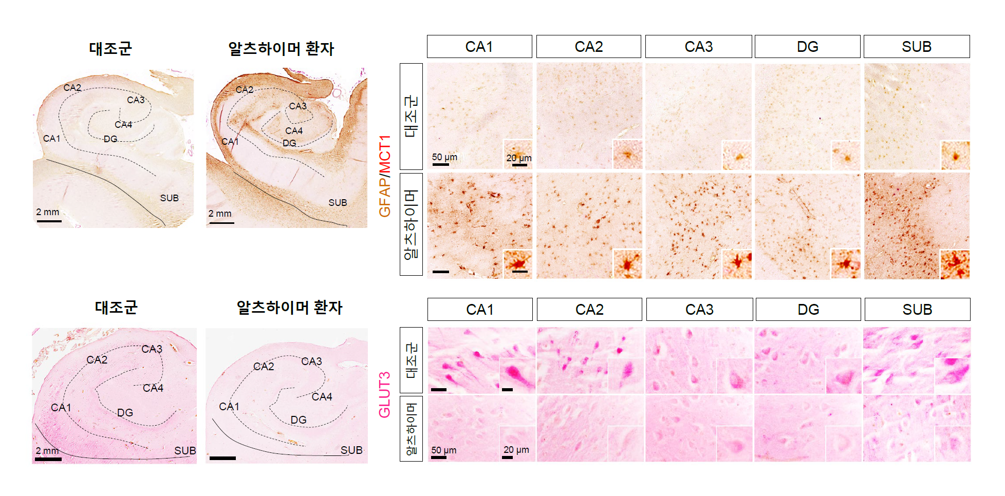 [그림 3] 알츠하이머 환자 뇌조직의 MCT1 및 GLUT3 변화