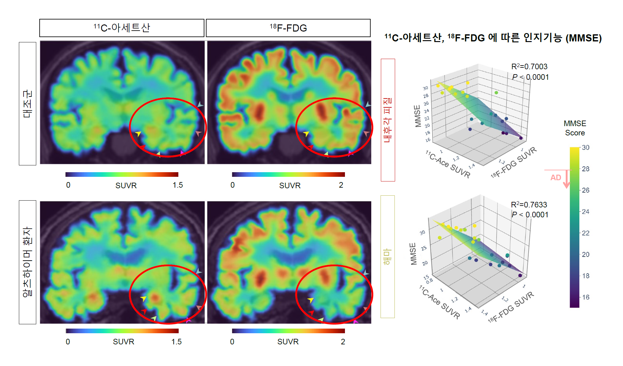 [그림 4] 알츠하이머 환자의 PET 영상 및 11C-아세트산 및 18F-FDG 흡수 변화에 따른 인지기능의 상관관계