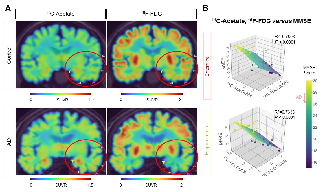 Figure 3. 11C-acetate and 18F-FDG imaging for visualizing reactive astrogliosis and the associated neuronal glucose hypometabolism in AD patients’ brains.