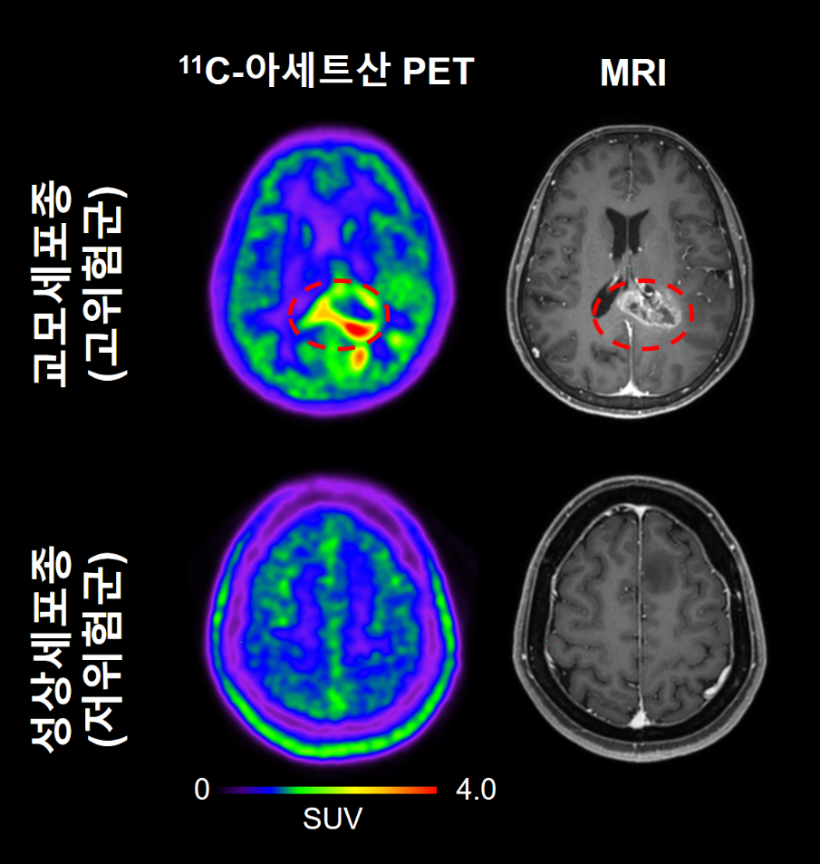 [그림 2] 교모세포종(고위험군) 환자와 성상세포종(저위험군) 환자에서 관찰되는 11C-아세트산 PET와 MRI 이미지