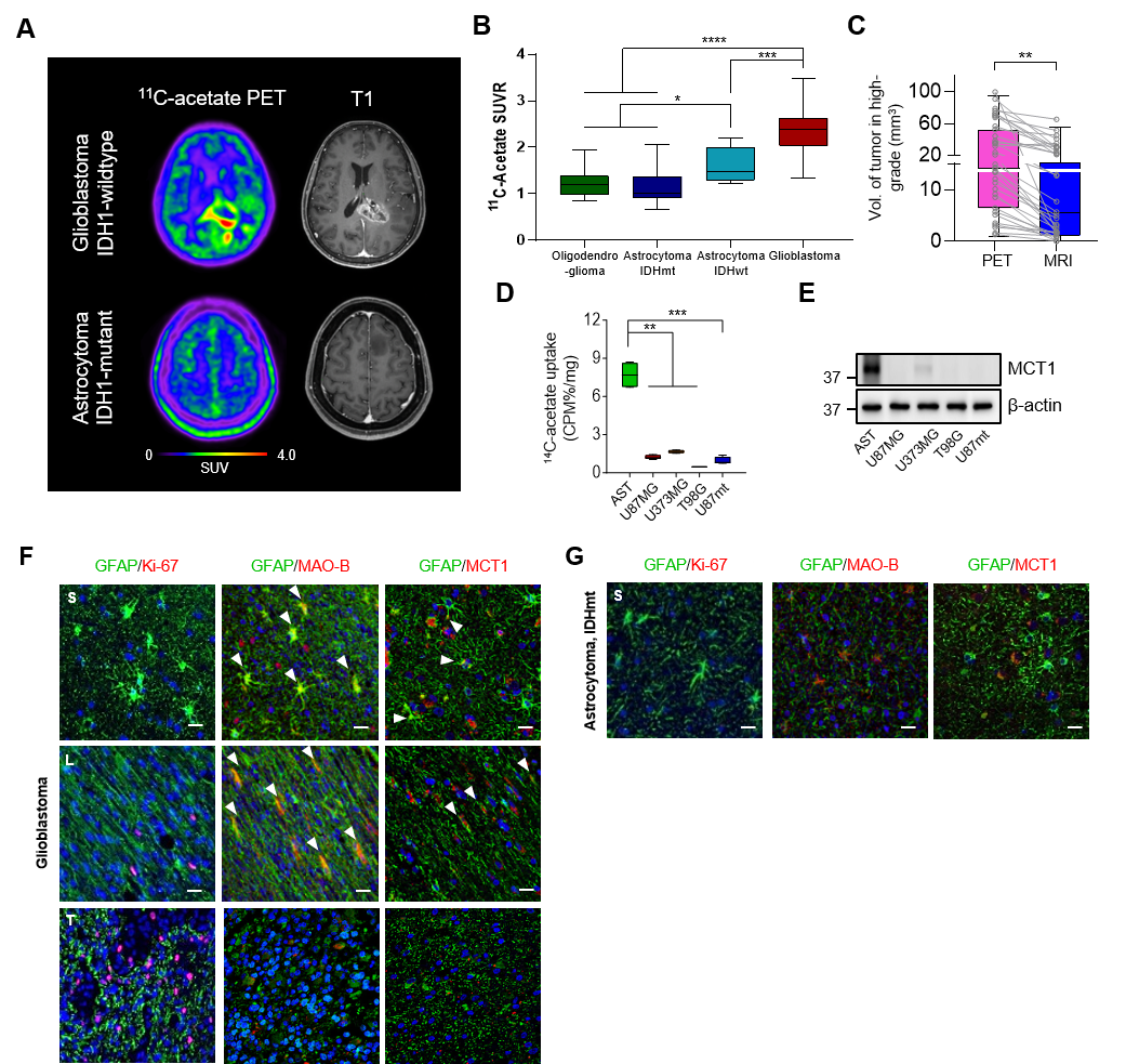 Figure 1. Regions of 11C-acetate uptake at the tumor boundary in patients with glioblastomas