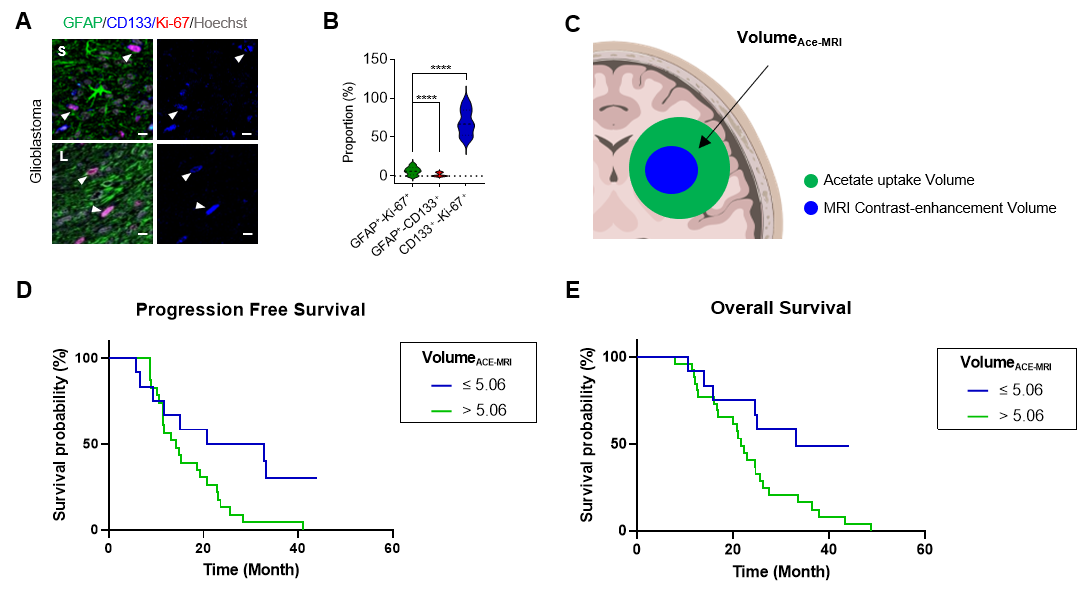 Figure 3. Relationship between volume of reactive astrogliosis and prognosis in patients with glioblastoma and cancer stem cells